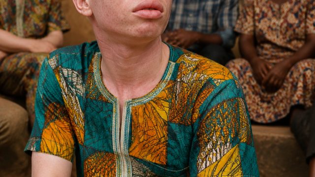 Empowering Individuals with Albinism: A Call to Action for Society