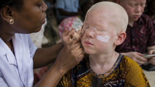 Addressing the Needs of Persons with Albinism: A Call to Action